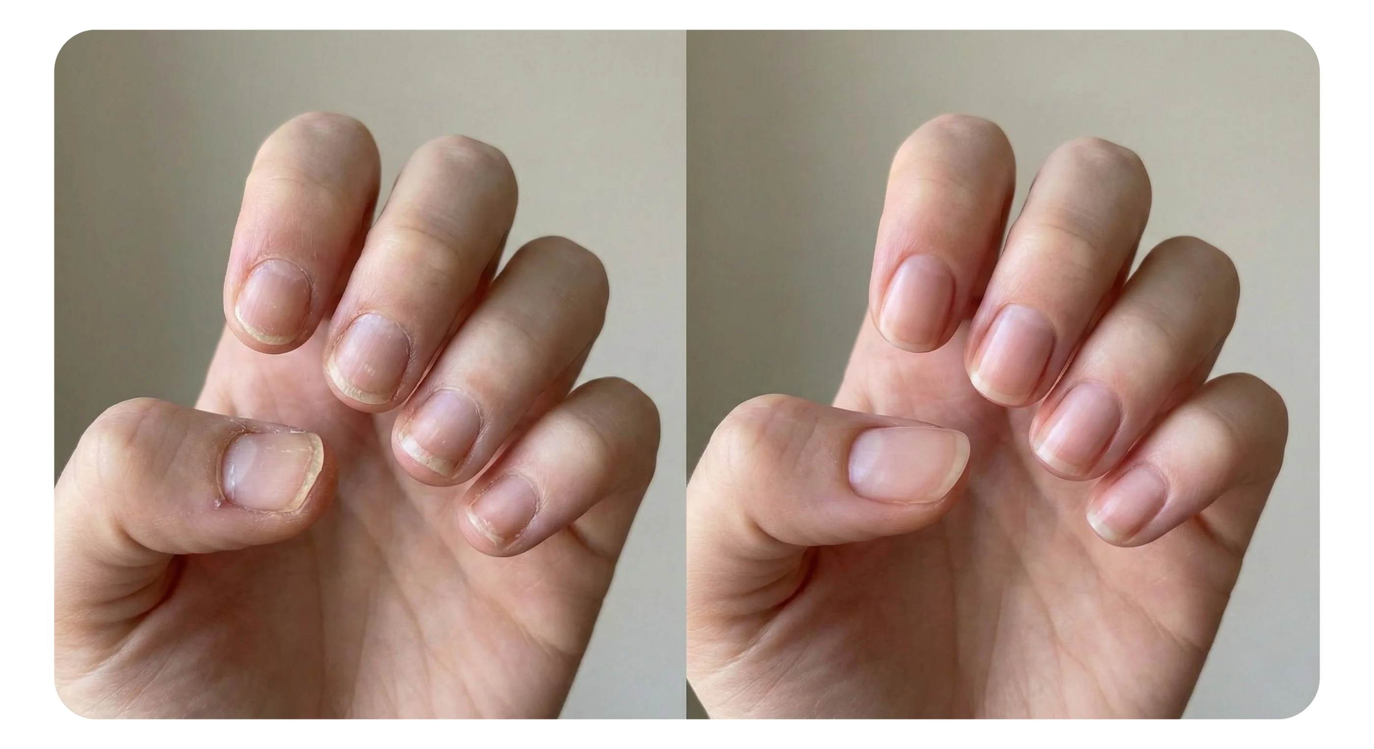 Avant après des ongles de Céline